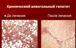 Токсический гепатит печени — симптомы, лечение острой и хронической формы