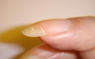 Загибаются ногти: в чем причина и как лечить