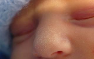 Прыщи у новорожденных: виды, причины появления, лечение